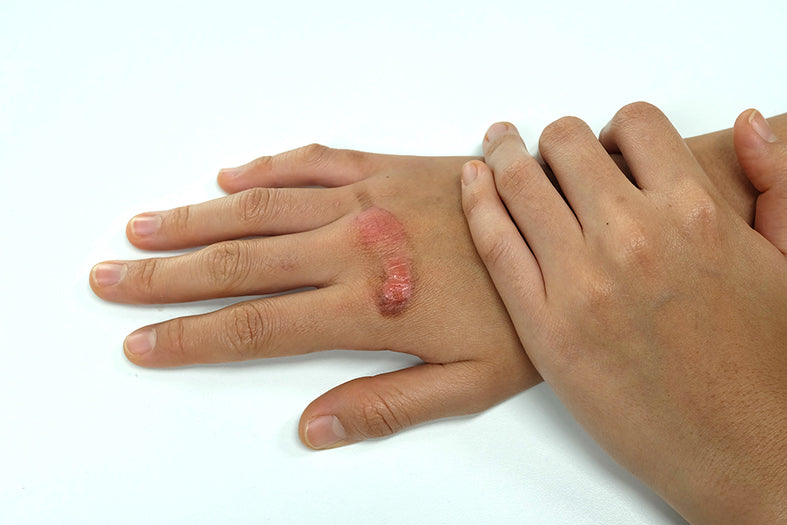 Abilar® Wound Balm | For wound treatment